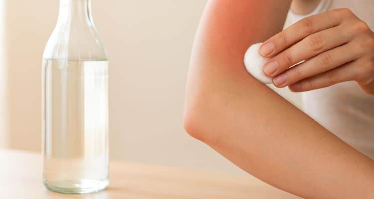 Applying white vinegar on sunburned skin for home relief
