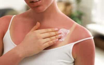 Burned by the Sun? 4 Easy DIY Sunburn Remedies You Can Try at Home