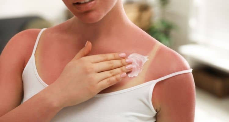 Burned by the Sun? 4 Easy DIY Sunburn Remedies You Can Try at Home